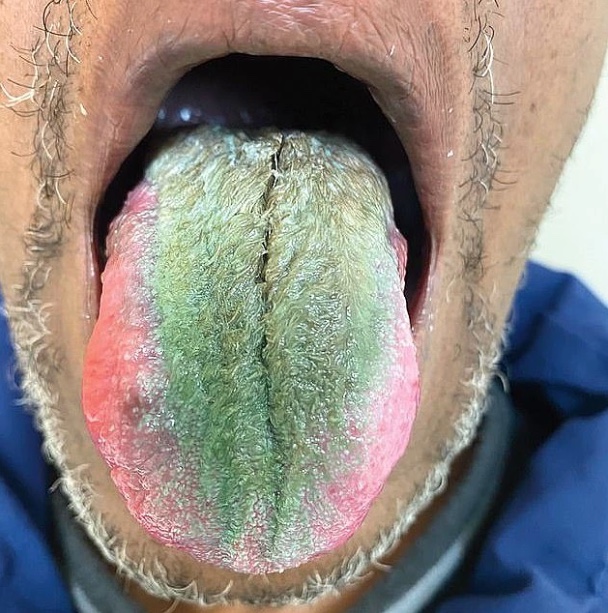 Caso raro de ‘língua peluda’ verde é identificado; entenda causas