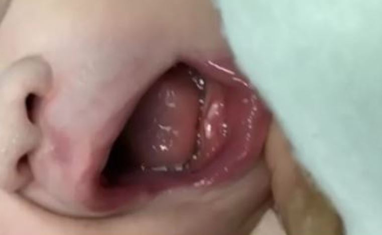 Mãe se assusta ao saber que bebê nasceu com dois dentes