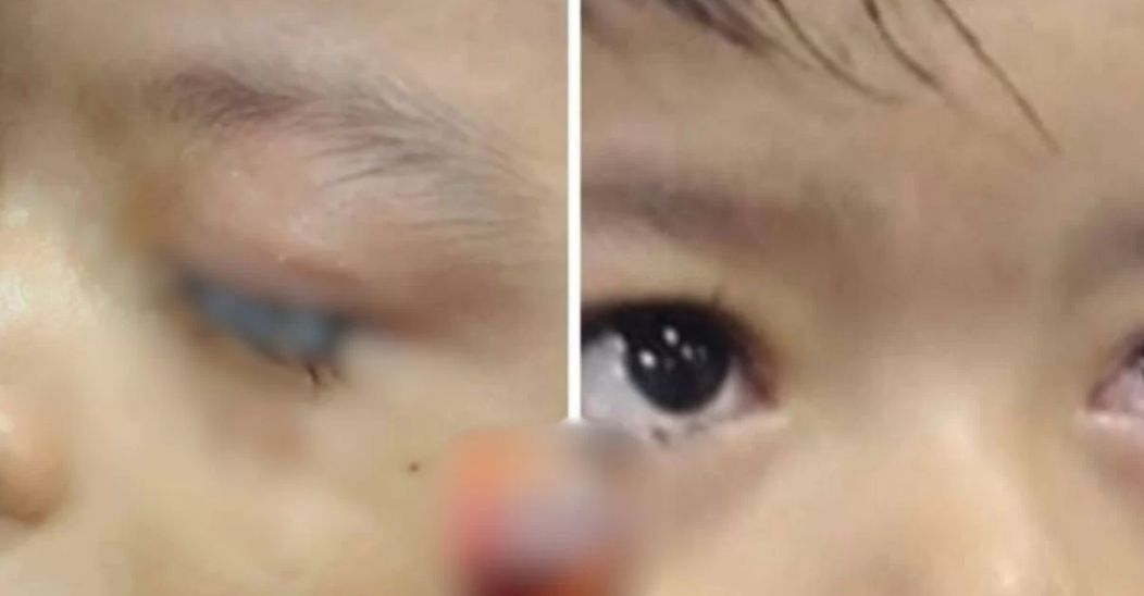 Criança de 2 anos tem olhos colados no Amazonas