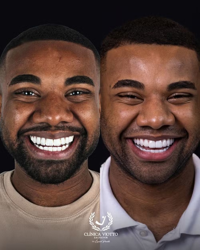 Ex-BBB Davi Brito investe R$ 60 mil em lentes de porcelana e muda o sorriso