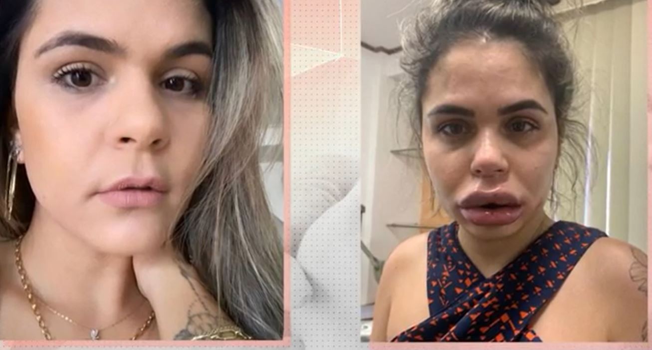 Dentista é acusada de deformar mais de 40 mulheres com harmonização facial