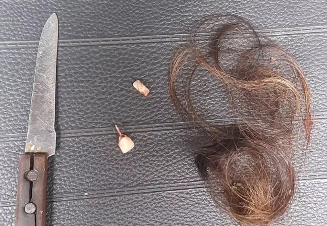 Mulher tem cabelo picotado e dentes quebrados ao ser agredida pelo namorado