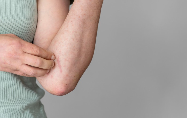 Especialista dá dicas para amenizar efeitos da dermatite atópica