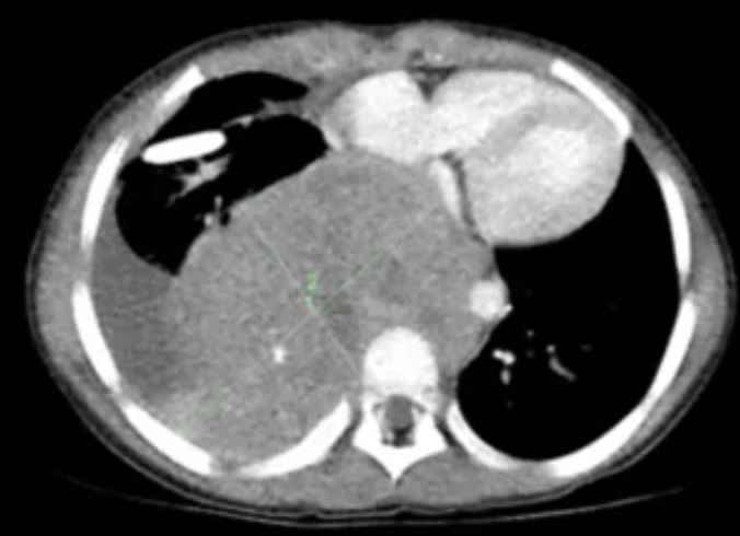 Neuroblastoma: farmacêutica submete remédio à aprovação do SUS