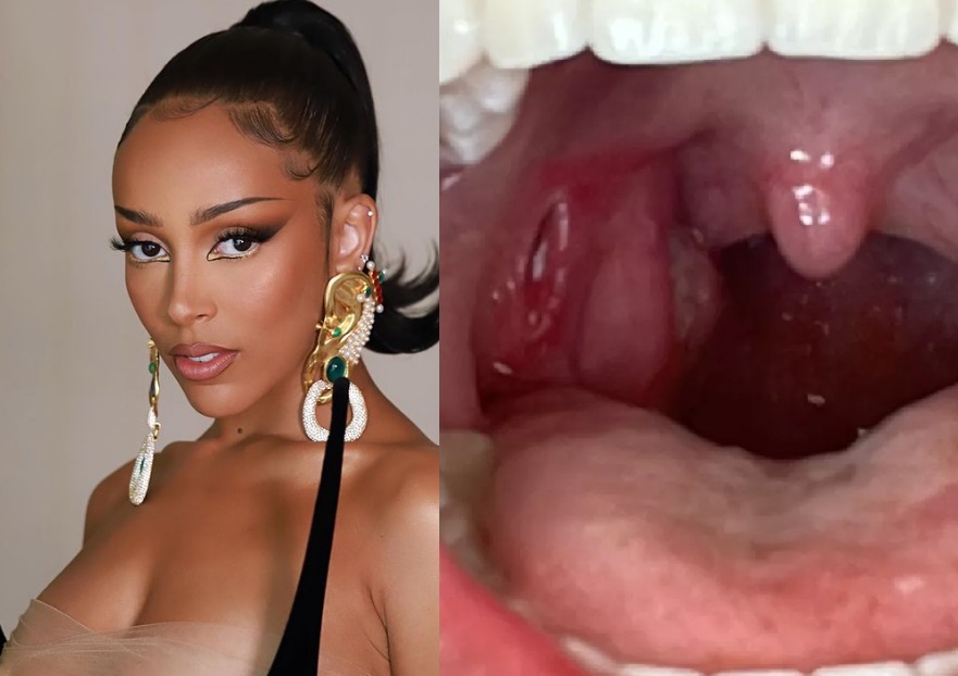 Doja Cat faz cirurgia de emergência após uso de cigarro eletrônico