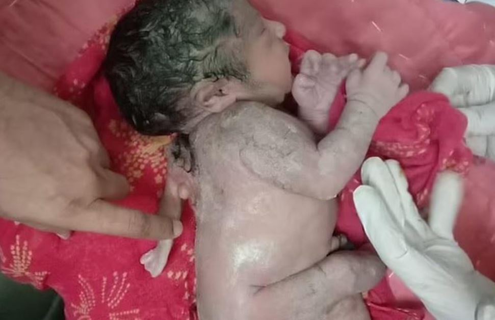 Bebê nasce com terceira mão nas costas e surpreende médicos