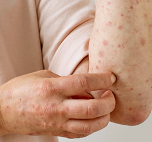 Norte fica em alerta após Rondônia confirmar quatro casos de Mpox 