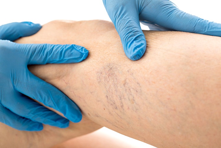 Tratamento de varizes sem acompanhamento médico pode levar à morte