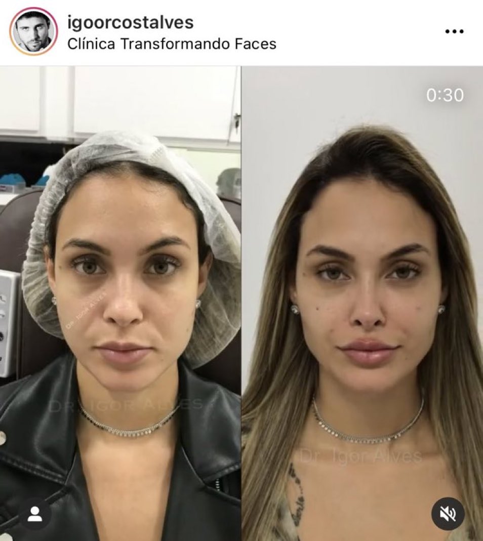 Ex-BBB Sarah faz harmonização facial com profissional que cuida de Gretchen