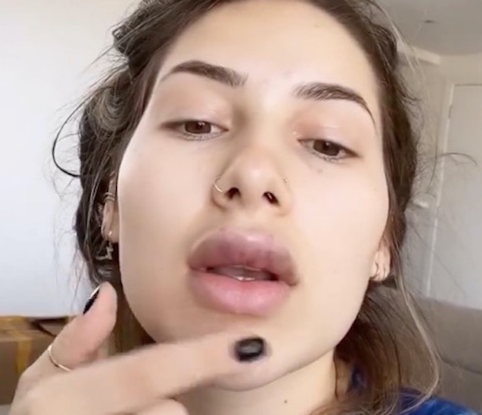 Virgínia Fonseca fica com boca inchada após novos procedimentos estéticos 