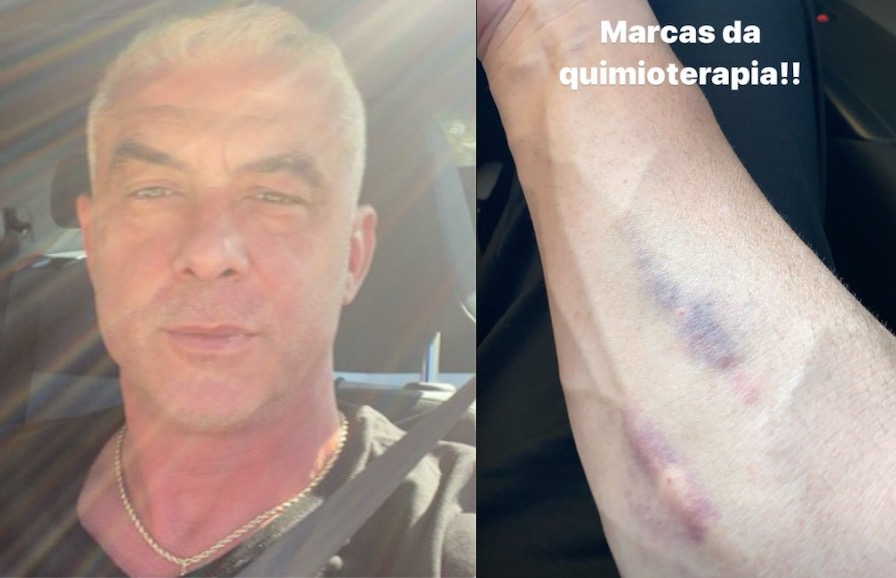Marido de Ana Hickmann, Alexandre Correa, mostra marcas da quimioterapia 