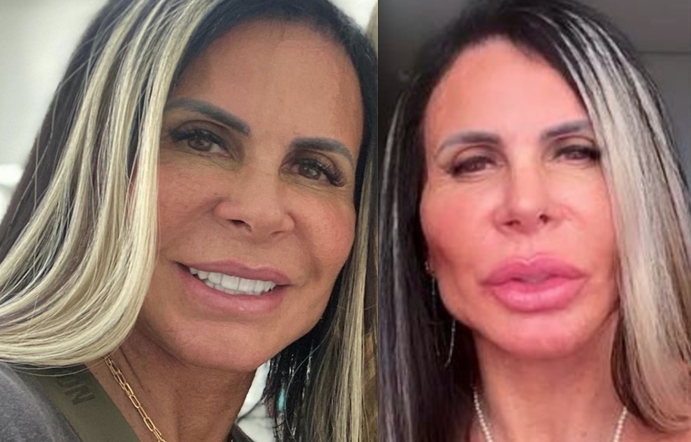 Gretchen e marido fazem harmonização facial; veja o resultado