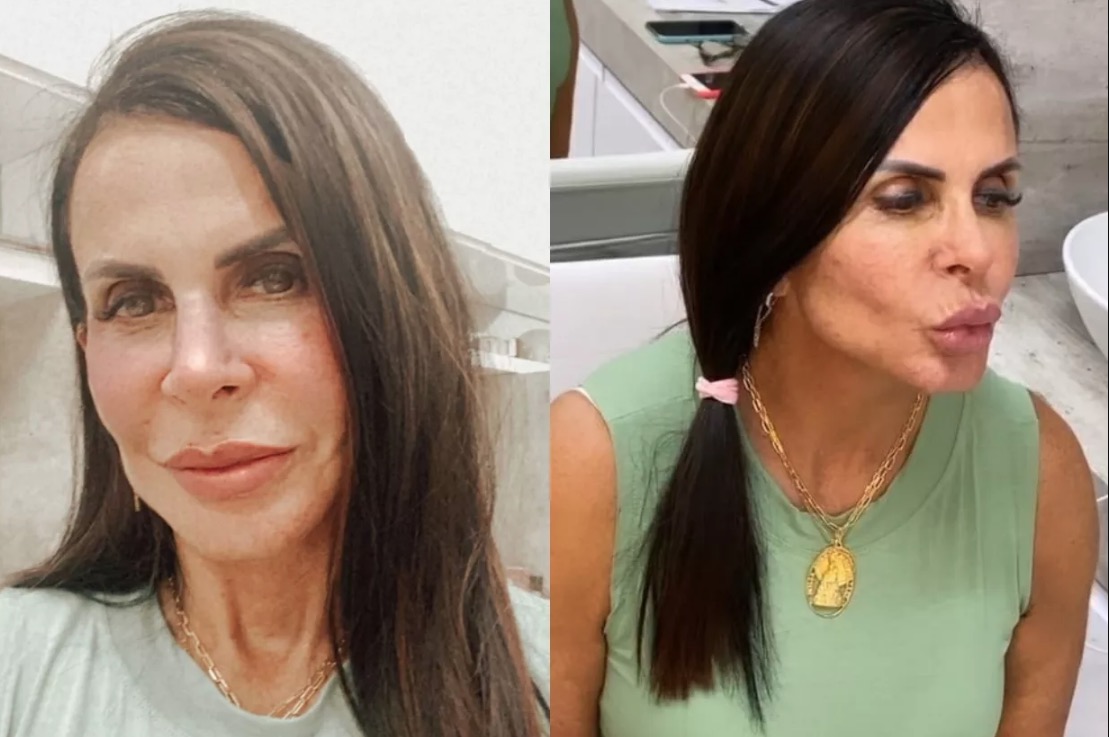 Prestes a se casar, Gretchen exibe resultado de nova harmonização facial