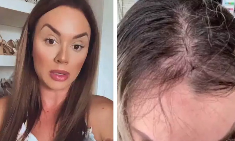 Juju Salimeni choca ao mostrar queda de cabelo por depressão