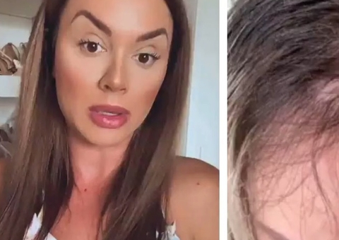 Juju Salimeni choca ao mostrar queda de cabelo por depressão