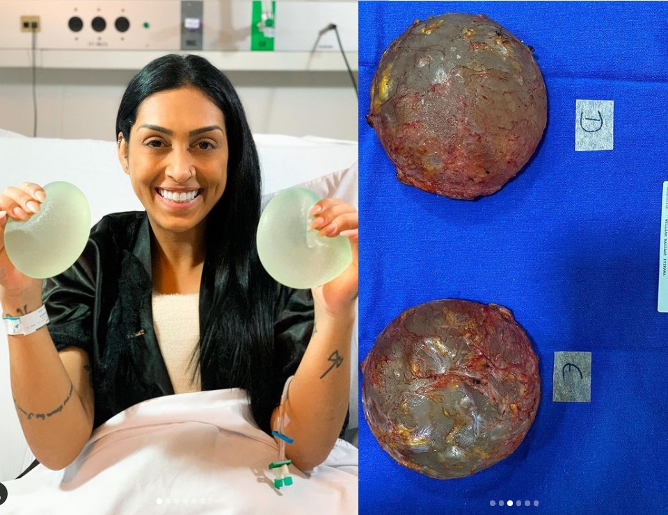 Ex-BBB Amanda retira silicone após 14 anos e comemora: ‘bomba relógio'