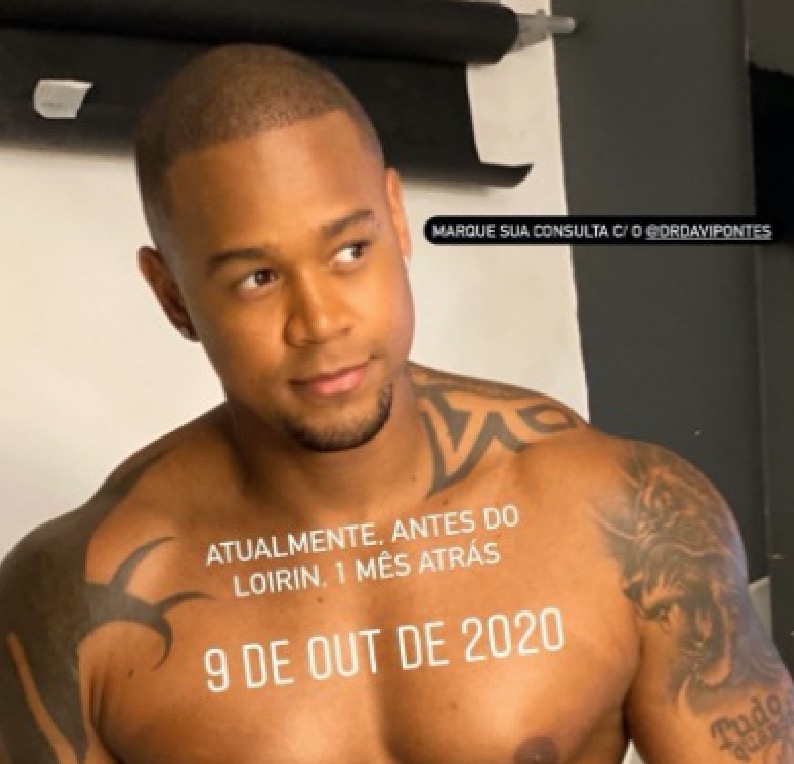 Leo Santana mostra resultado de transplante capilar: 'adeus às entradinhas'