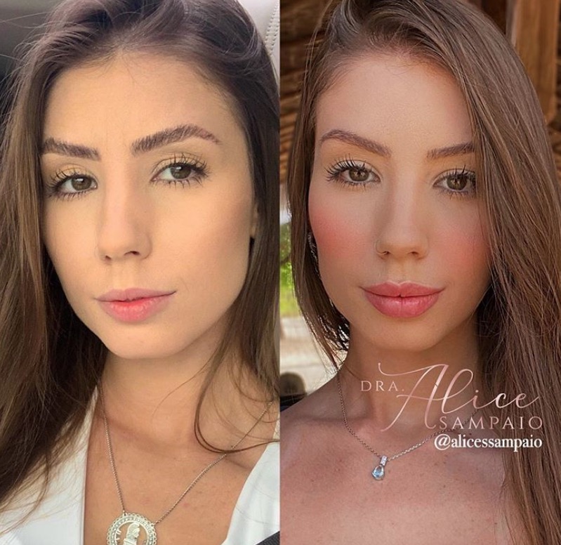 Namorada de Whindersson Nunes faz harmonização facial; veja o resultado