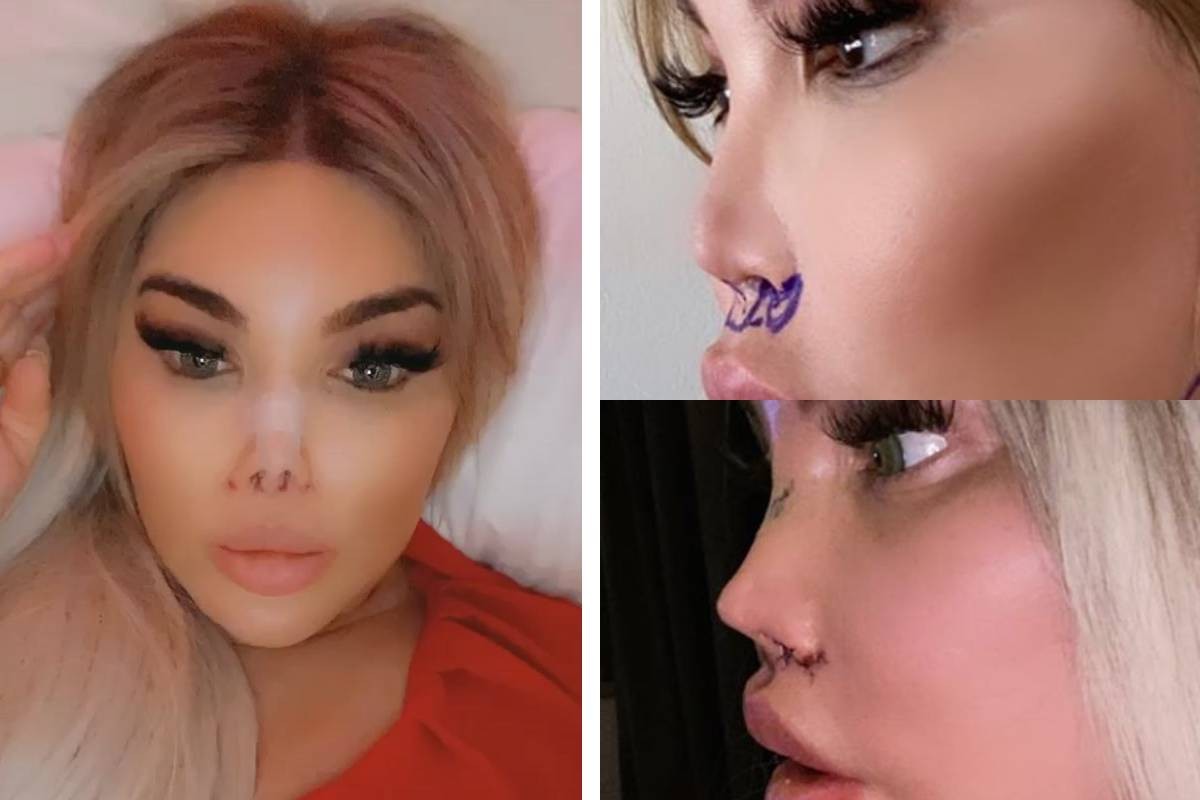 Ex-Ken Humano, Jéssica Alves, opera nariz pela segunda vez 