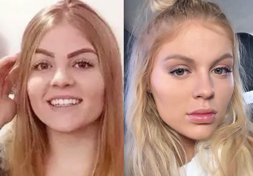 Luísa Sonza revela que nunca fez harmonização e explica mudança no rosto