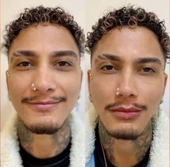 Dynho Alves, ex de MC Mirella, faz harmonização facial; Veja antes e depois