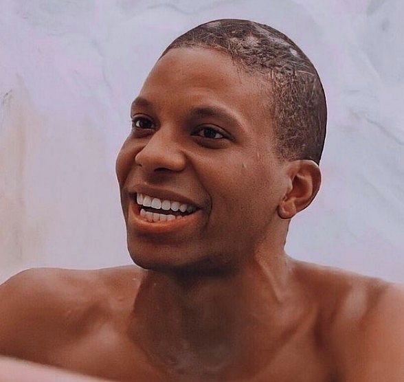 Alopecia: Entenda o que são as falhas no cabelo de Lucas do BBB21