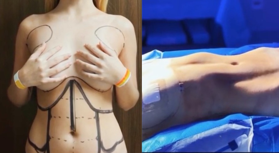 Aos 18, Giovanna Chaves mostra resultado de lipo LAD após críticas 