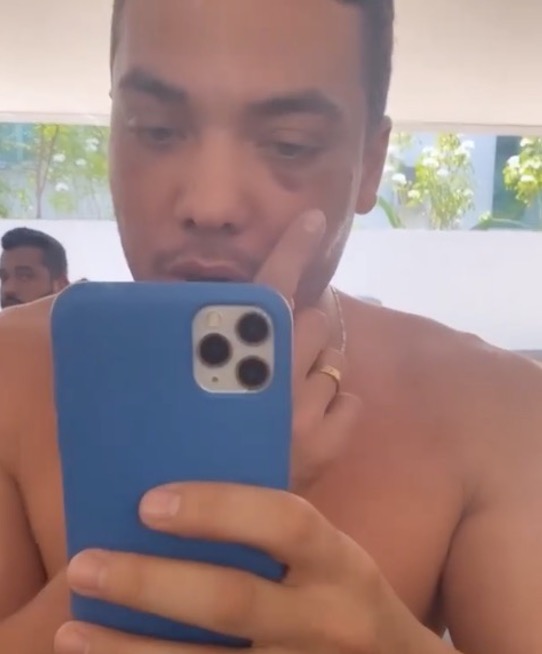 Wesley Safadão surge com olho roxo após novo procedimento estético 