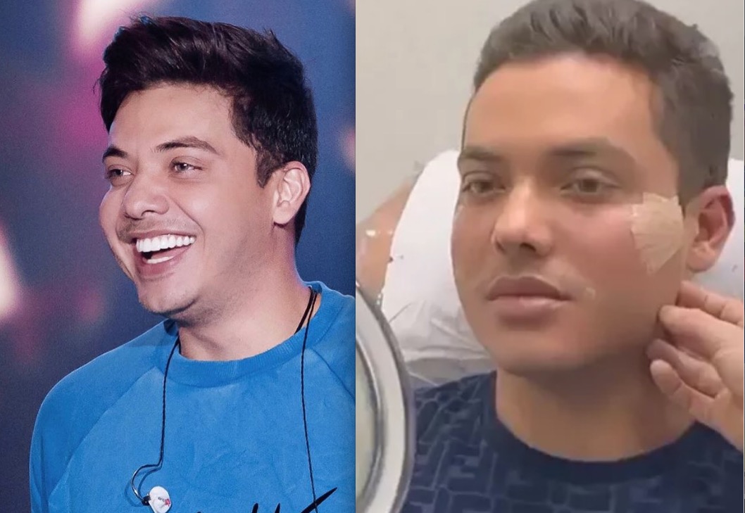 Wesley Safadão faz harmonização facial; veja como ficou 