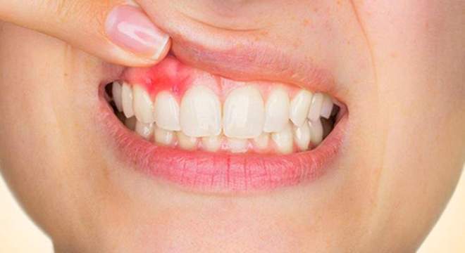 Sexo oral sem camisinha também causa câncer de cabeça e pescoço