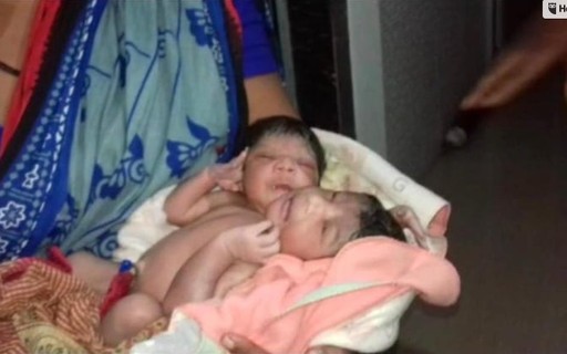Mulher dá luz à gêmeas siamesas com três braços 