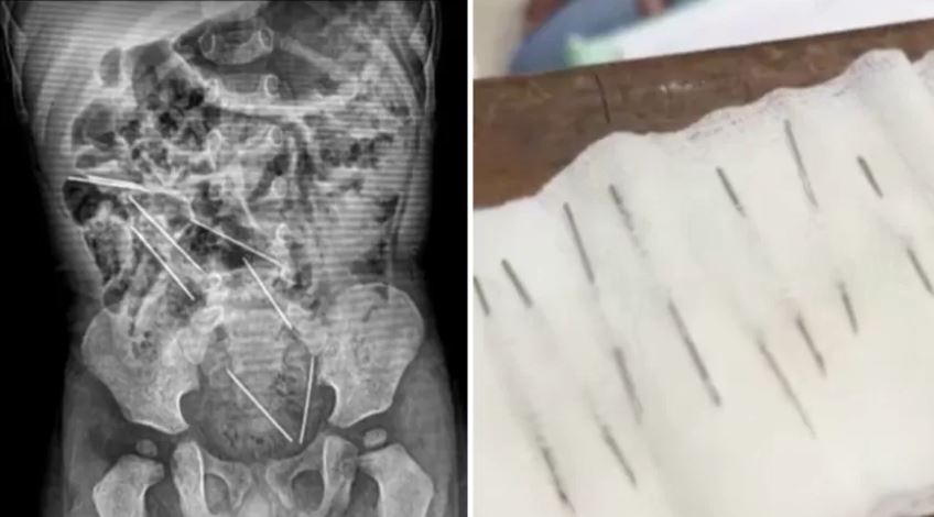 Menino de 2 anos tem 8 agulhas retiradas do estômago