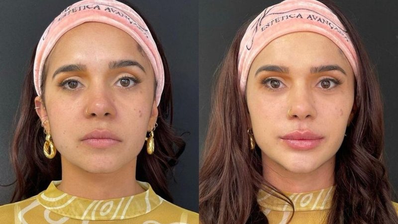 Ex-BBB Gizelly Bicalho faz harmonização facial; veja o resultado