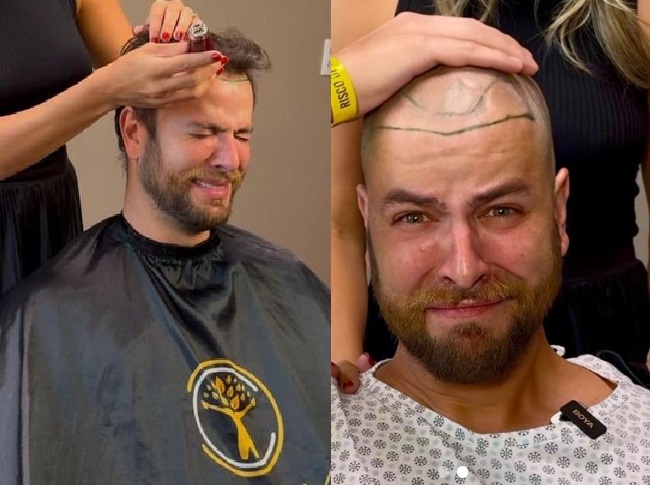 Ex-BBB Gustavo Marsengo faz transplante capilar com pelos pubianos