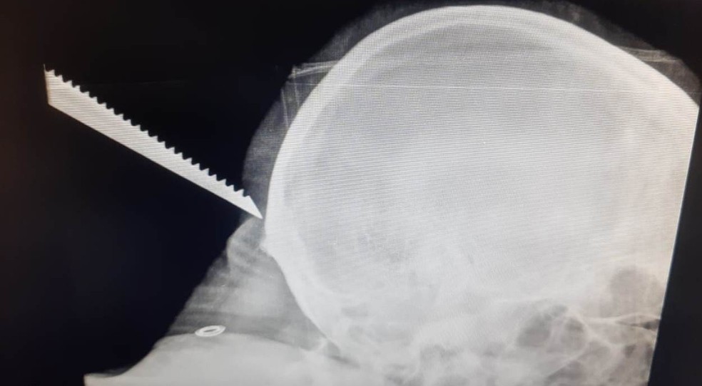 Pedreiro fica com serra cravada na nuca durante acidente em obra