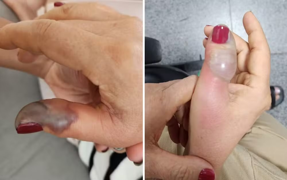 Infecção após manicure leva mulher a perder parte do dedo em SP