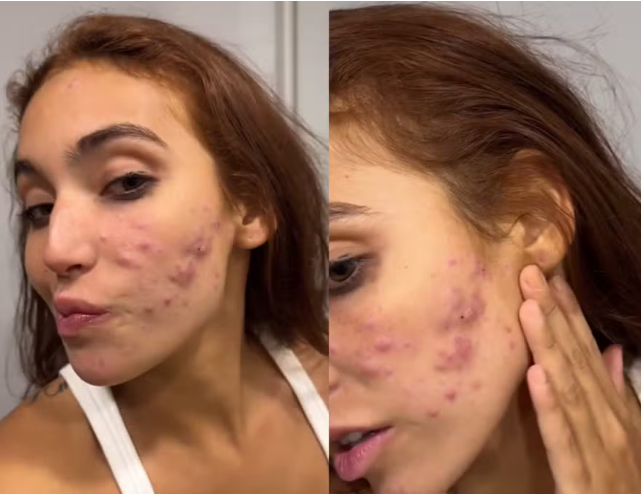 Vanessa Lopes mostra rosto cheio de espinhas e desabafa: “Não aguento mais”