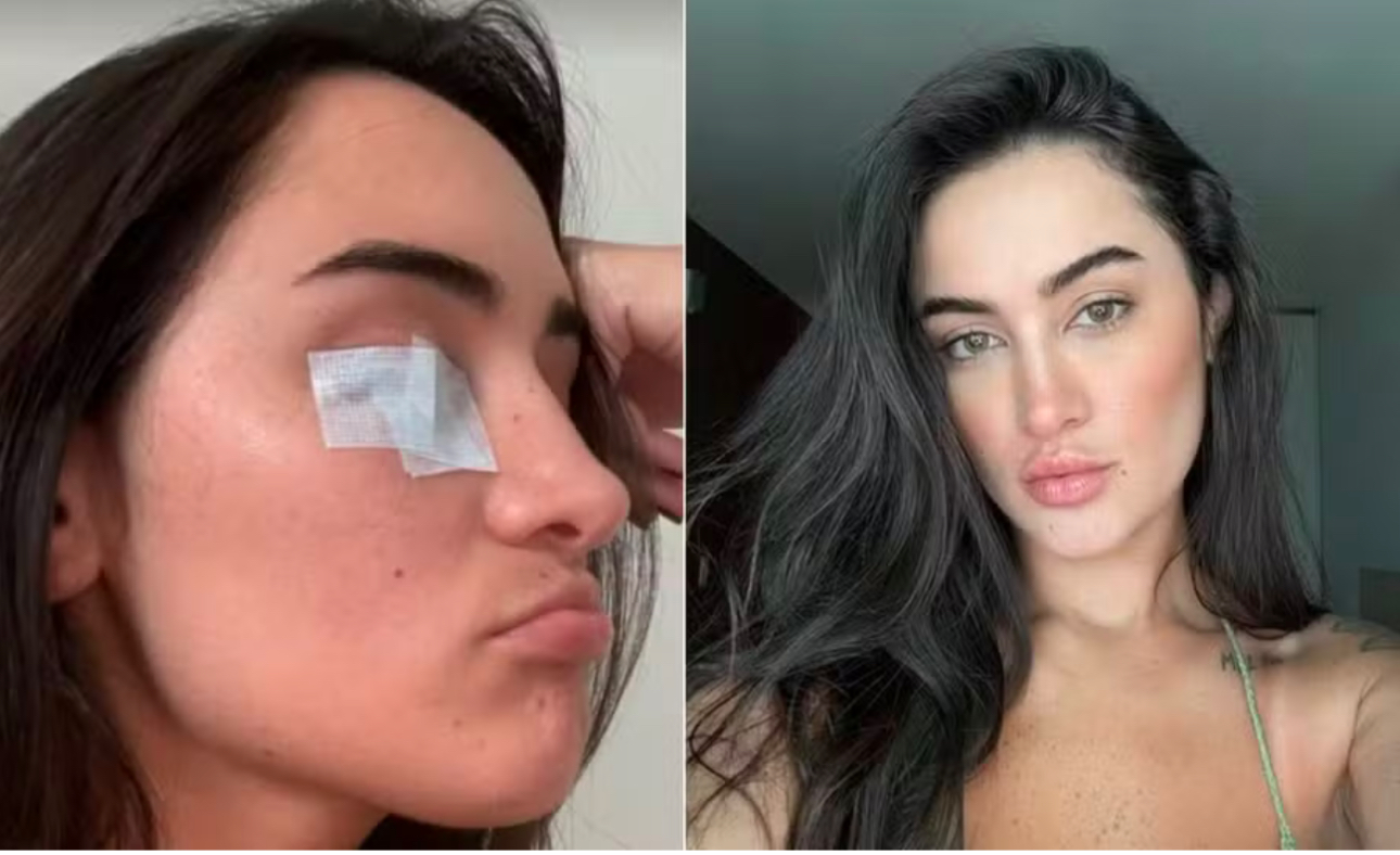 Gabi Melim é diagnosticada com paralisia de Bell: “meu rosto não mexe”