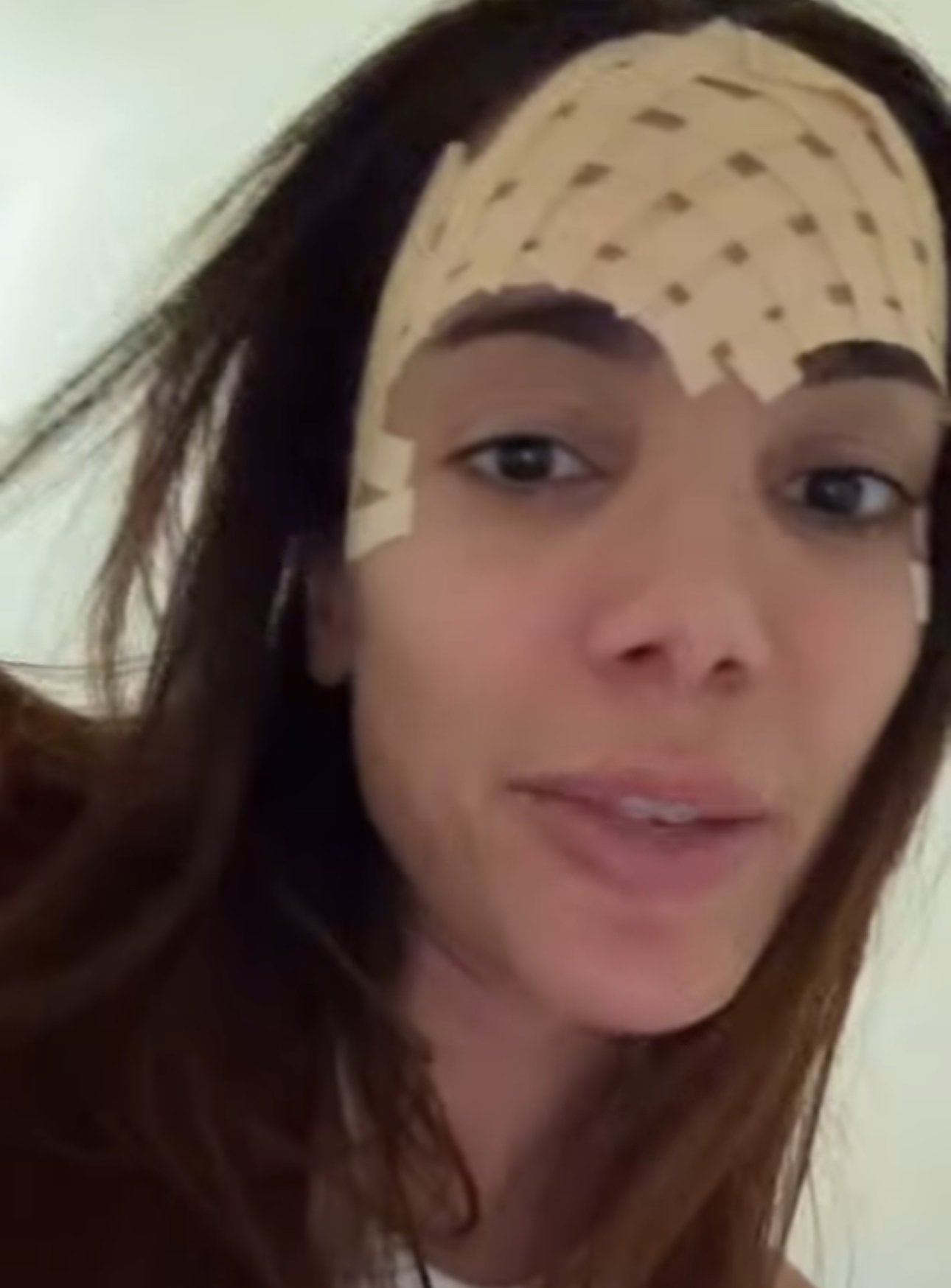 Anitta passa por procedimento para retirar veia saltada da testa 