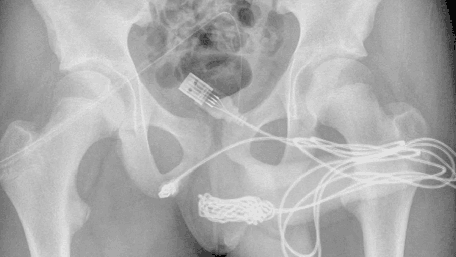 Jovem tenta medir tamanho do pênis e acaba com cabo na uretra