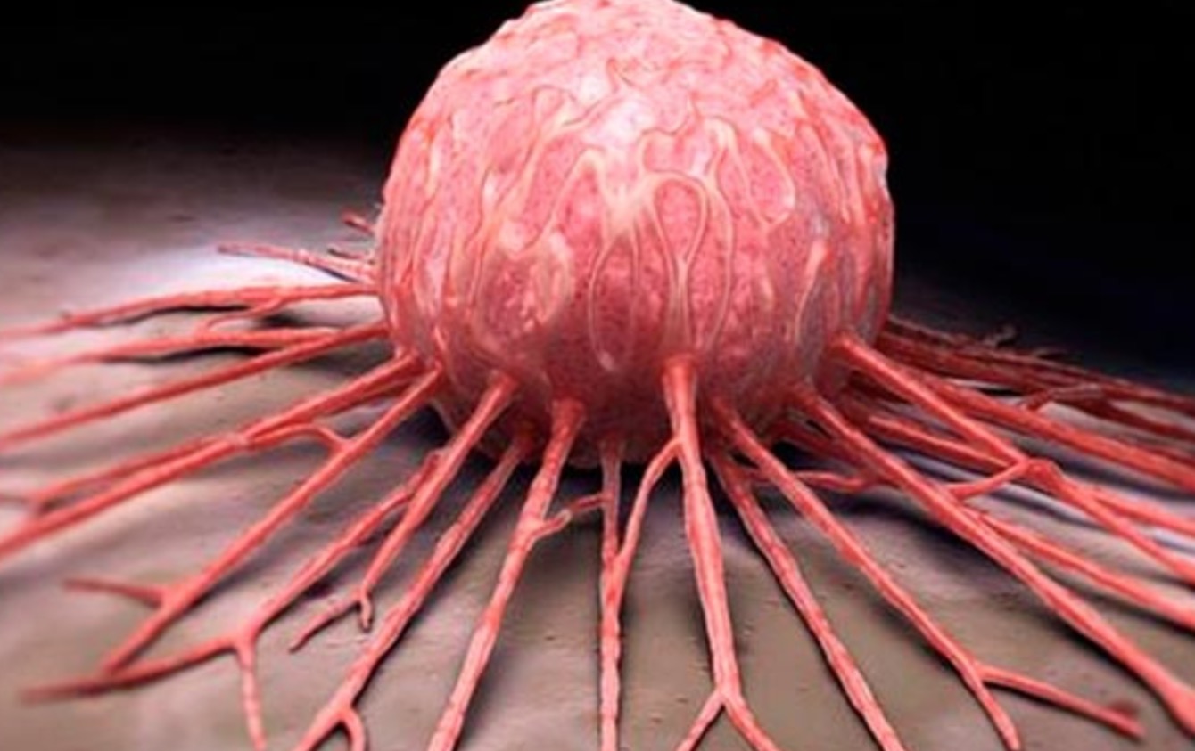 Primeiro homem curado do HIV enfrenta câncer terminal 