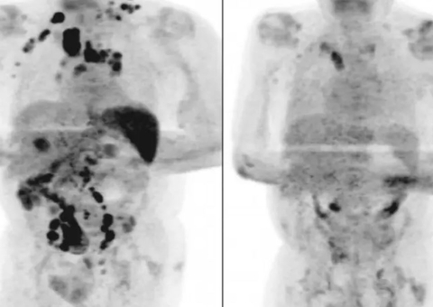Idoso infectado por Covid teve redução de câncer em estágio avançado