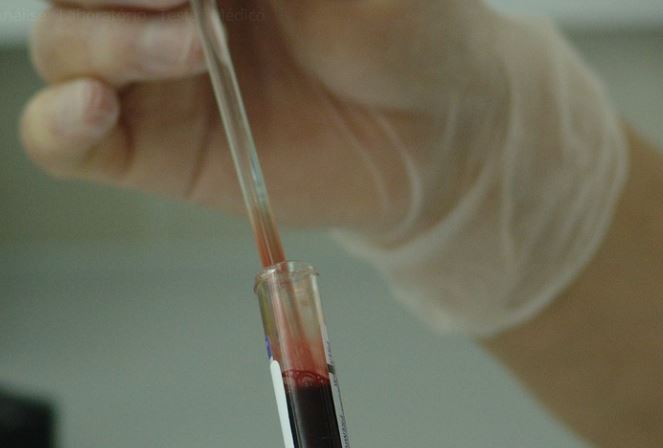 Genética: Garota de 13 anos é curada de câncer com células modificadas