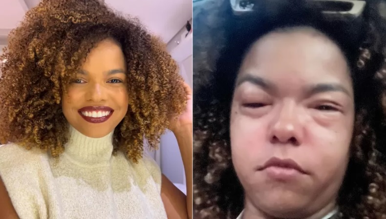 Jeniffer Nascimento fica com rosto deformado ao ter reação alérgica 