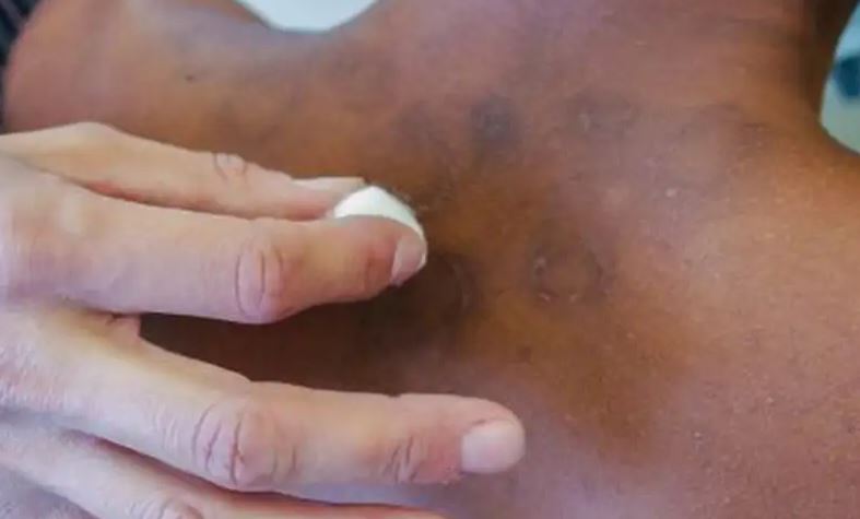 Filhos de isolados por hanseníase no passado vão receber pensão