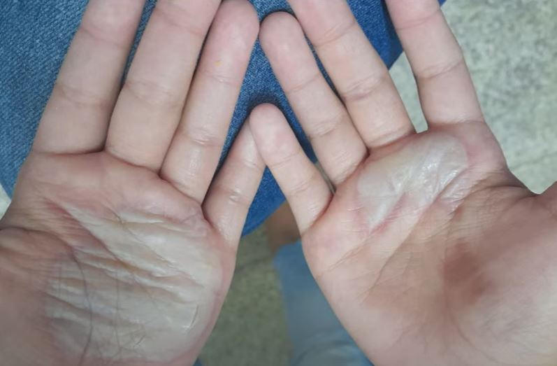 Mãe é presa após queimar mãos de criança com colher quente em Manaus