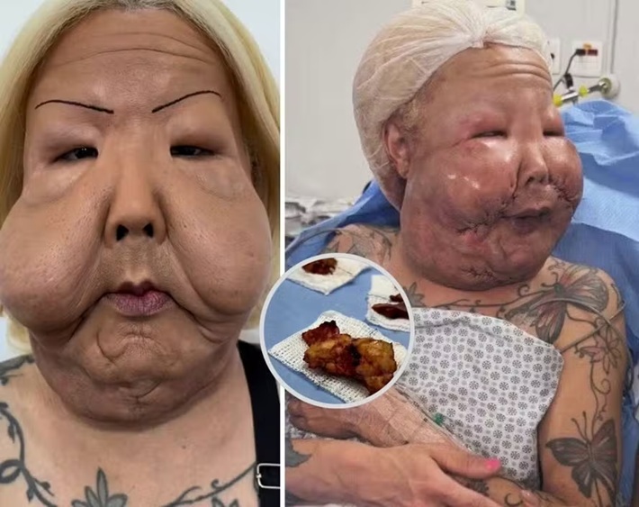 Médico mostra óleo mineral retirado do rosto de Juju do Pix: 'endurecido'