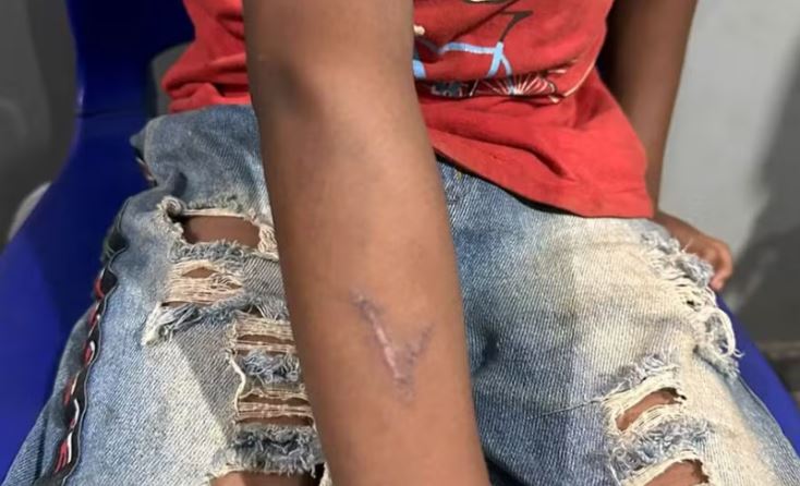 Criança indígena é queimada com ferro de marcar gado por pecuarista