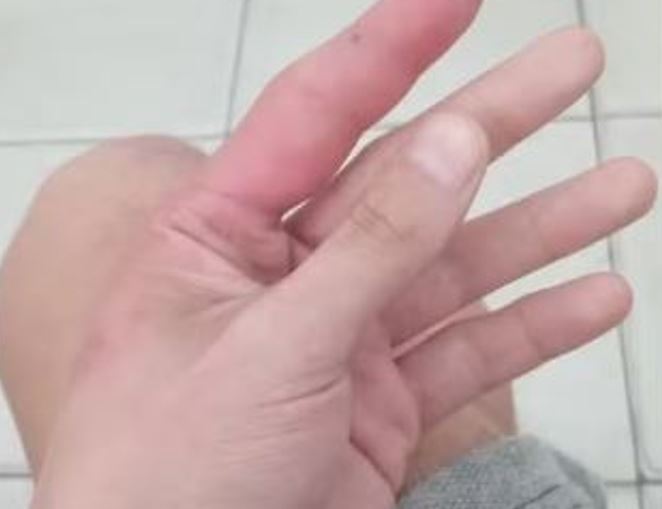 Homem perde o dedo após ser picado por aranha venenosa