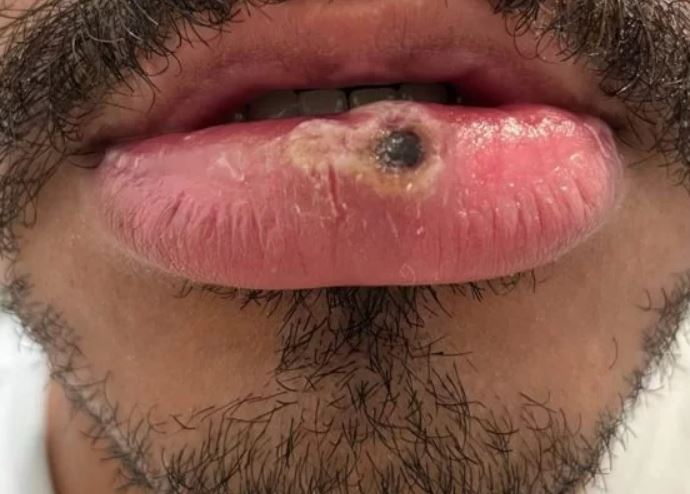 Amazonas registra mais 3 casos suspeitos de varíola dos macacos 